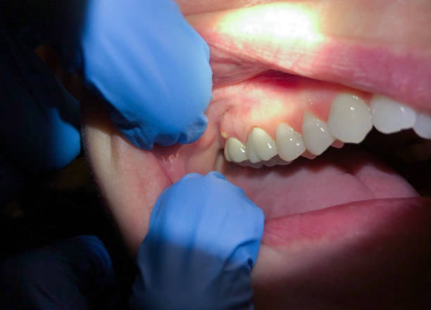 Best Emergency Tooth Extraction in Bristol, CT